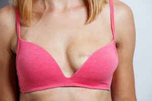 Managing Scar Tissue