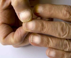 Nail Care