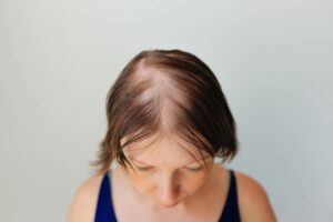 Hair Loss